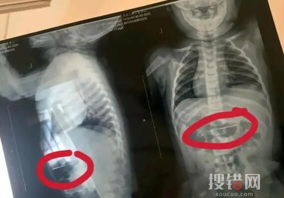 寶媽稱醫院誤將針掉進孩子胃中 為什么掉進胃中？