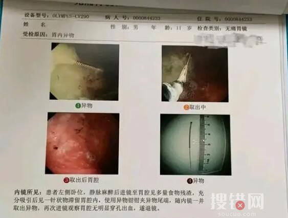 寶媽稱醫院誤將針掉進孩子胃中 為什么掉進胃中？