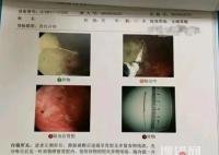 寶媽稱醫院誤將針掉進孩子胃中 為什么掉進胃中？