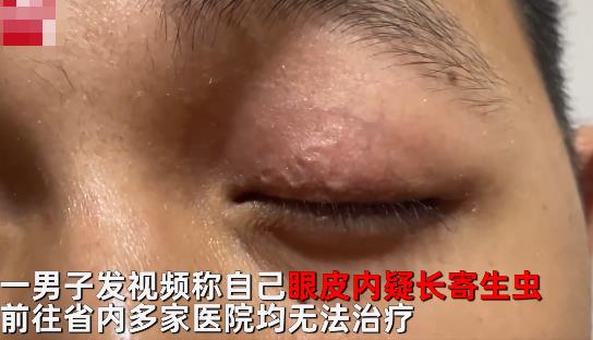 男子左眼皮異常抖動有蟲游走 眼皮上怎么會有蟲?