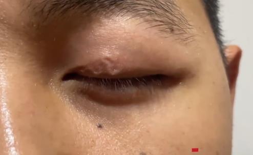 男子左眼皮異常抖動(dòng)有蟲游走 眼皮上怎么會(huì)有蟲?