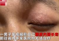 男子左眼皮異常抖動有蟲游走 原因竟是這樣太意外了