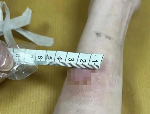 女子稱卷發棒爆炸致手臂二度燙傷 具體事件經過是什么?