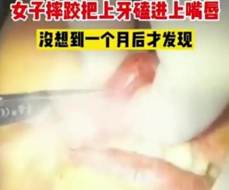 女子摔跤上牙磕進嘴唇1月后才發現 到底是什么情況?
