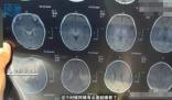 月嫂拍嗝時打盹致嬰兒頭頂骨骨折 真相曝光簡直太驚人了