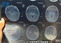 月嫂拍嗝時打盹致嬰兒頭頂骨骨折 真相曝光簡直太驚人了