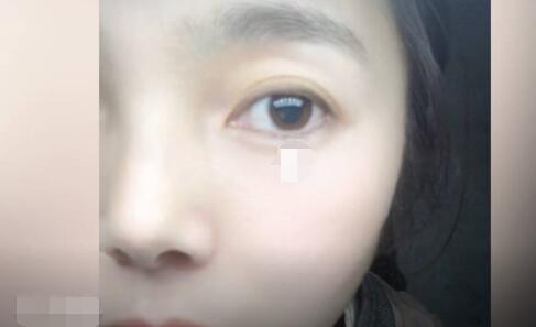 女子左眼瞳孔變大2倍找不到病因 究竟是怎么回事？
