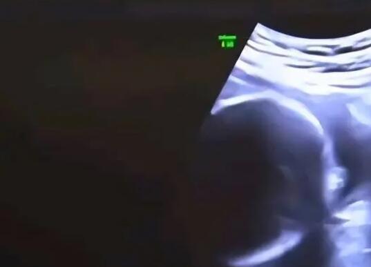 結(jié)婚6年沒孩子 查出丈夫非男性 究竟是怎么回事？