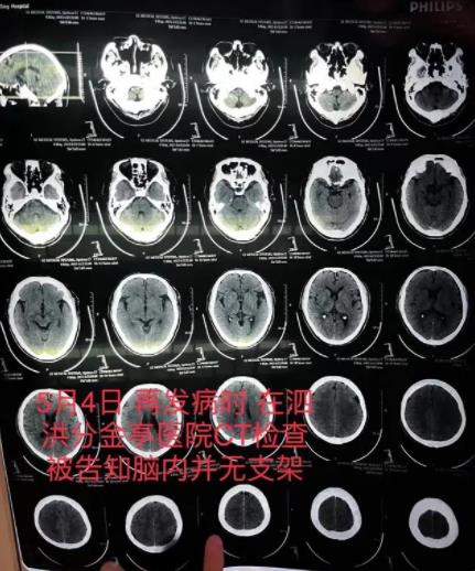 老人腦梗去世 醫生隱瞞未植入支架