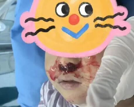 奶奶向3歲男童鼻腔塞頭發止血 真相到底是什么?