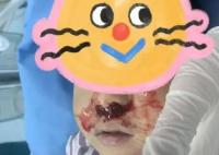 奶奶向3歲男童鼻腔塞頭發止血 背后原因簡直驚呆了眾人