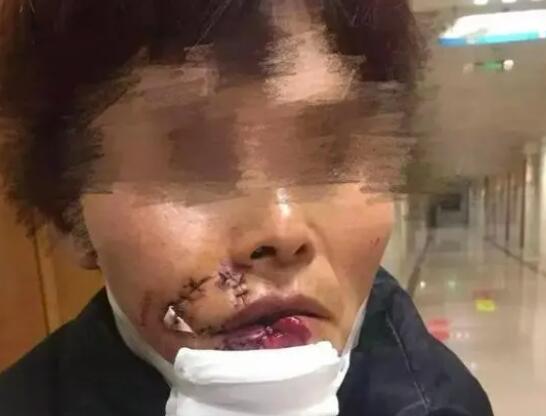 女子被狗撕碎左臉縫了500多針 始料未及真相簡直太意外了
