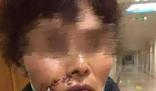 女子被狗撕碎左臉縫了500多針 始料未及真相簡直太意外了