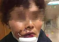 女子被狗撕碎左臉縫了500多針 始料未及真相簡直太意外了