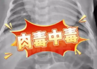 52天嬰兒喝奶奶喂的蜂蜜水中毒進ICU 事件始末2025最新消息