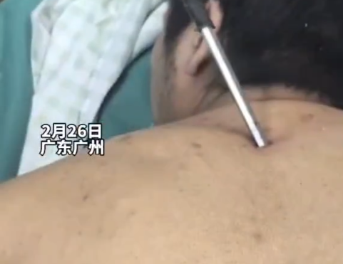 高空掉落30cm螺絲刀直插男子胸腔 切記不要自行拔除異物