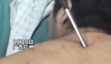 高空掉落30cm螺絲刀直插男子胸腔 切記不要自行拔除異物
