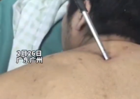高空掉落30cm螺絲刀直插男子胸腔 切記不要自行拔除異物