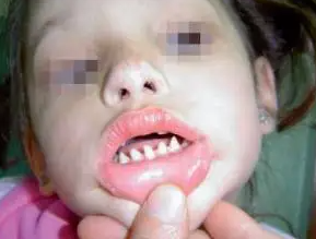 長哪吒同款鯊魚牙可能患有罕見病 背后真相實在讓人驚愕