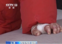 女孩確診“蝴蝶寶貝”皮膚一碰就碎 真相簡直太意外了