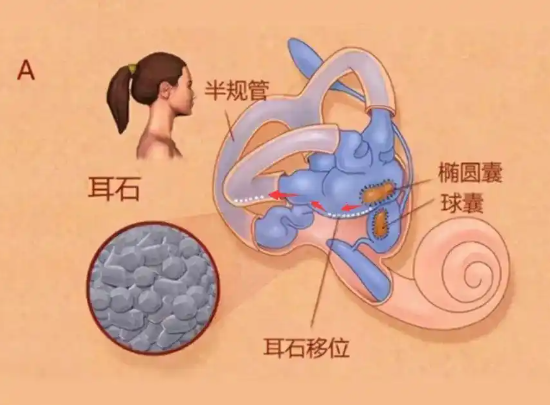 25歲女子長(zhǎng)期熬夜打麻將患耳石癥 內(nèi)幕實(shí)在讓人驚個(gè)呆