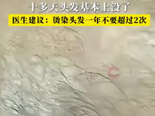 男子一月染頭4次致頭發大量脫落 內幕實在讓人驚個呆