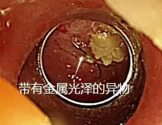 老人突發(fā)高燒拍胸片意外發(fā)現(xiàn)魚鉤 究竟是怎么回事？