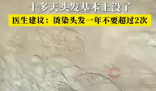 男子一月染頭4次致頭發大量脫落 內幕實在讓人驚個呆