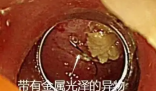 老人突發高燒拍胸片意外發現魚鉤 究竟是怎么回事？
