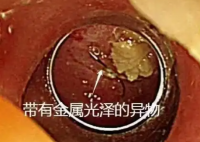 老人突發(fā)高燒拍胸片意外發(fā)現(xiàn)魚鉤 究竟是怎么回事？