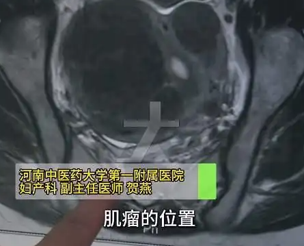 女子愛(ài)生悶氣子宮里長(zhǎng)了8個(gè)瘤 背后真相實(shí)在讓人驚愕