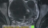 女子愛生悶氣子宮里長(zhǎng)了8個(gè)瘤 背后真相實(shí)在讓人驚愕