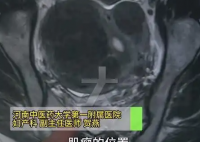 女子愛生悶氣子宮里長了8個瘤 背后真相實在讓人驚愕